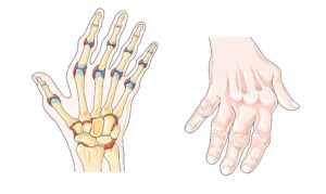 artritis reumatoide